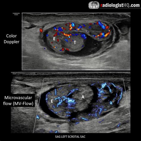 appendix testes torsion|Pediatric torsion of the appendix testis and appendix epididymis.